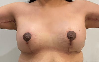 Breast Lift Before & After Gallery - Patient 396613 - Image 2