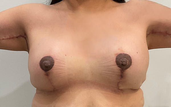 Breast Lift Before & After Gallery - Patient 396613 - Image 2
