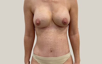 Tummy Tuck Before & After Gallery - Patient 268946 - Image 2