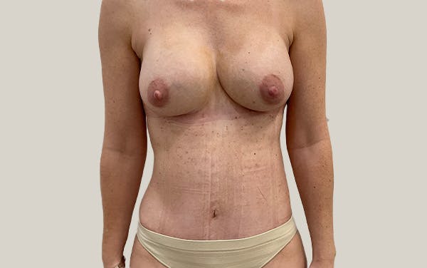 Tummy Tuck Before & After Gallery - Patient 268946 - Image 2