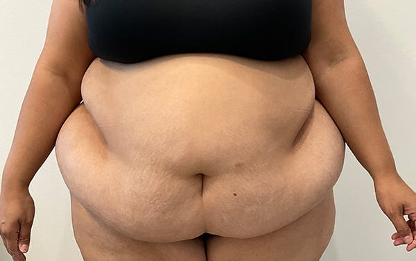 Tummy Tuck Before & After Gallery - Patient 395631 - Image 1