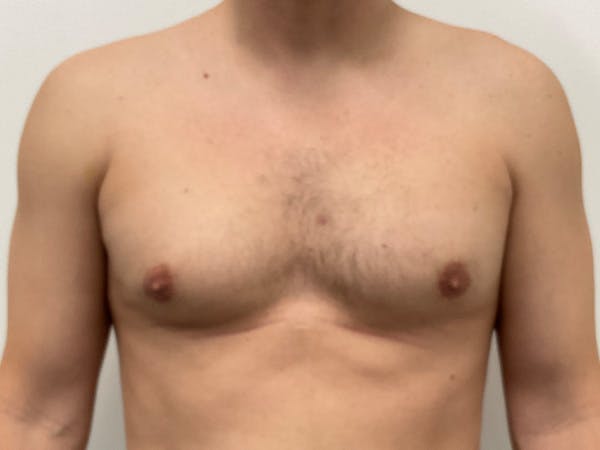 Gynecomastia Before & After Gallery - Patient 379655 - Image 1