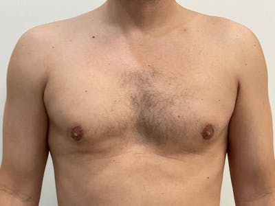 Gynecomastia Before & After Gallery - Patient 379655 - Image 2