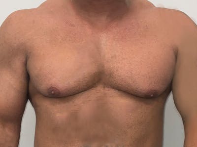 Gynecomastia Before & After Gallery - Patient 312514 - Image 1
