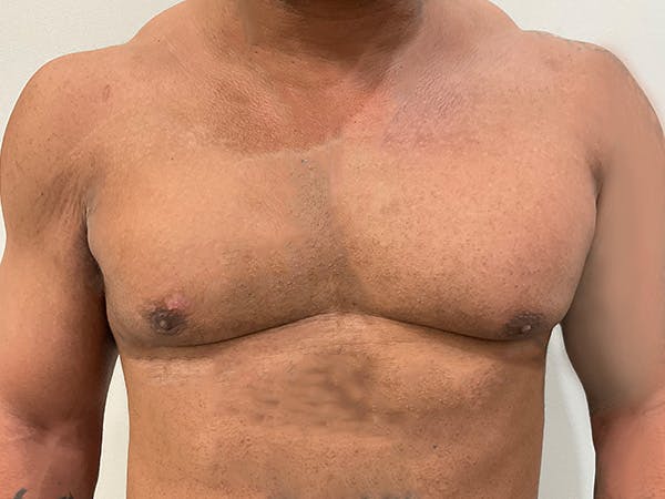 Gynecomastia Before & After Gallery - Patient 312514 - Image 2