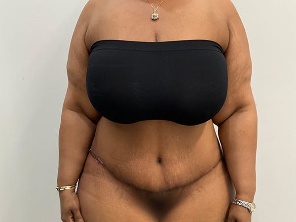 Upper Back Lift Before & After Gallery - Patient 175098 - Image 2