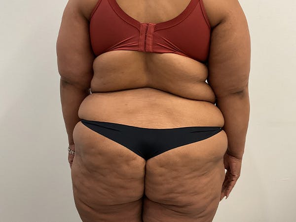 Upper Back Lift Before & After Gallery - Patient 175098 - Image 3