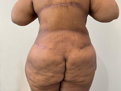 Upper Back Lift Before & After Gallery - Patient 175098 - Image 4