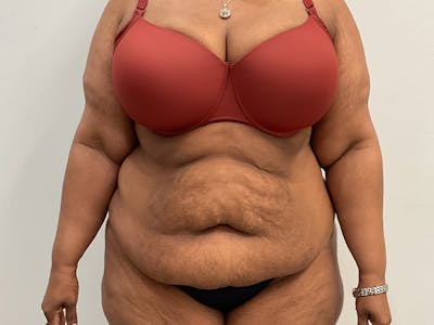 Upper Back Lift Before & After Gallery - Patient 175098 - Image 1