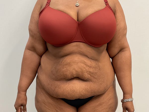 Upper Back Lift Before & After Gallery - Patient 175098 - Image 1