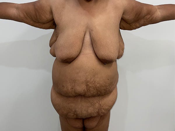 Tummy Tuck Before & After Gallery - Patient 229770 - Image 1