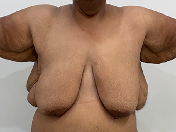 Breast Lift Before & After Gallery - Patient 407417 - Image 1