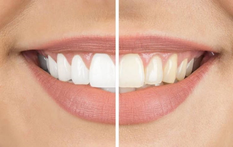 Teeth Whitening East Bay