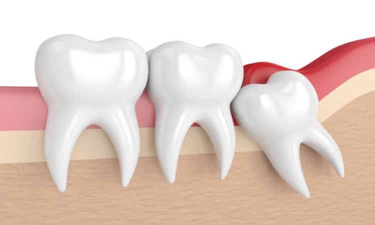 Wisdom Teeth East Bay Area