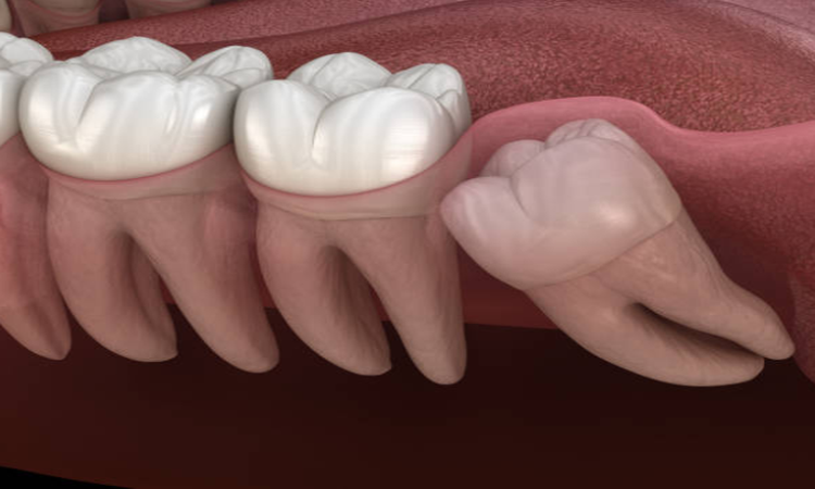 Samadian Cosmetic & Advanced Dentistry Blog | When do wisdom teeth come in?