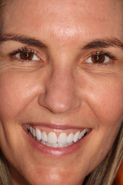 Veneers Before & After Gallery - Patient 56174737 - Image 2