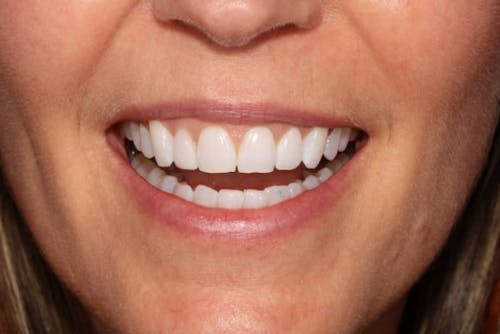 No-Prep Veneers