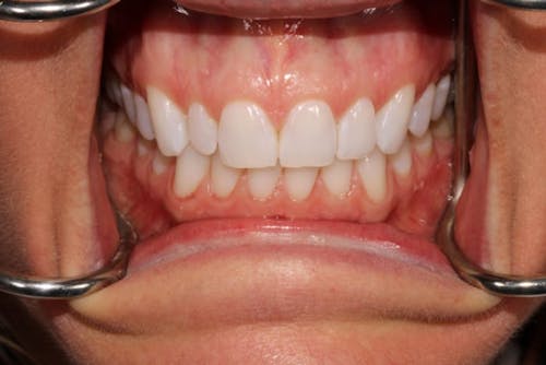 No-Prep Veneers