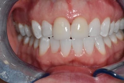 Veneers Before & After Gallery - Patient 56175437 - Image 1