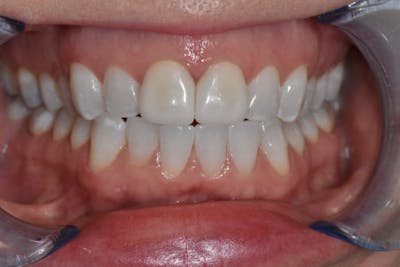 Veneers Before & After Gallery - Patient 56175437 - Image 2