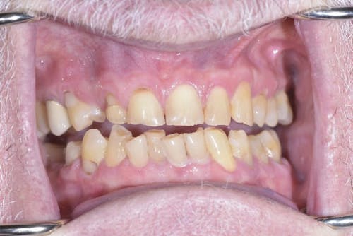 Before and after a Smile Makeover in San Francisco with Dr. Samadian