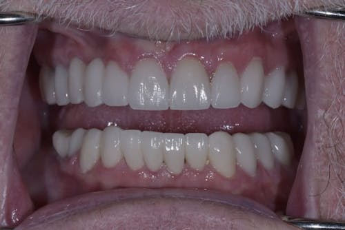 Before and after a Smile Makeover in San Francisco with Dr. Samadian