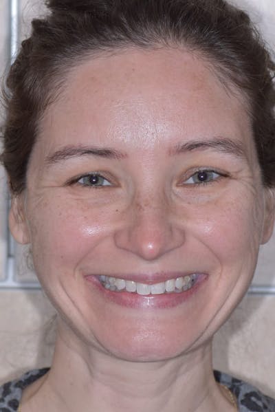 Veneers Before & After Gallery - Patient 56174943 - Image 1