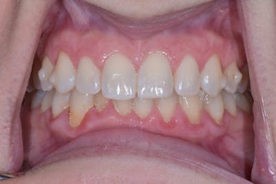 Veneers Before & After Gallery - Patient 56174943 - Image 3