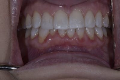 Veneers Before & After Gallery - Patient 56174943 - Image 4