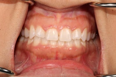 Gum Lift Before & After Gallery - Patient 39578175 - Image 1