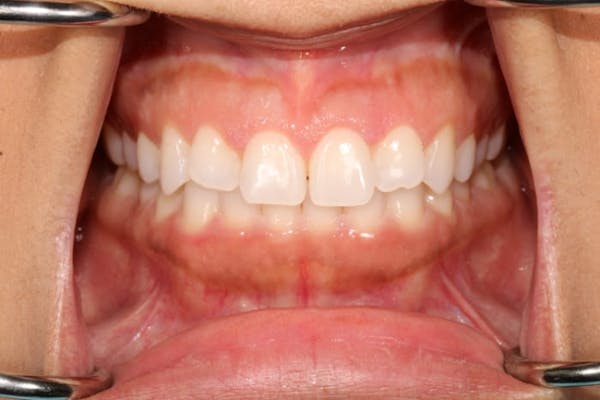 Gum Lift Before & After Gallery - Patient 39578175 - Image 2