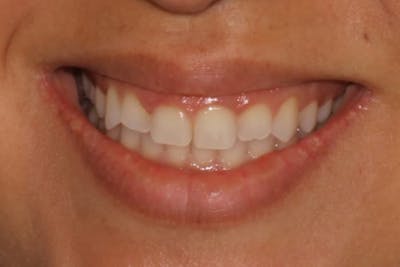 Gum Lift Before & After Gallery - Patient 39578175 - Image 3