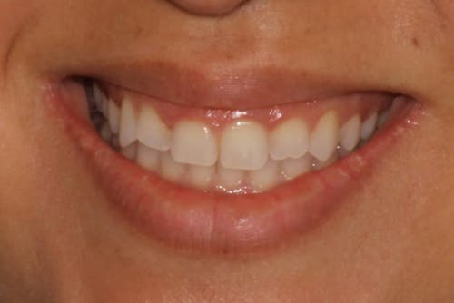 Before and after Same Day Veneers in San Francisco with Dr. Samadian