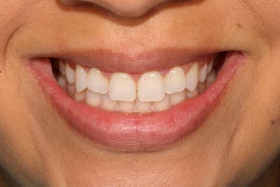 Veneers Before & After Gallery - Patient 39774549 - Image 4