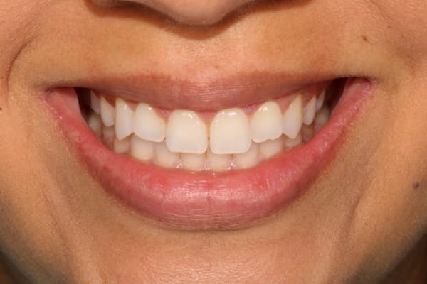 Veneers Before & After Gallery - Patient 39774549 - Image 4