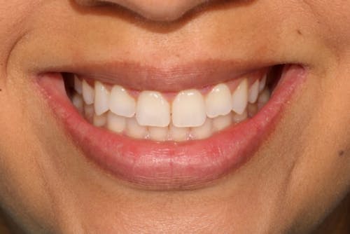Before and after Same Day Veneers in San Francisco with Dr. Samadian
