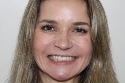 Smile Makeover Before & After Gallery - Patient 39578467 - Image 1