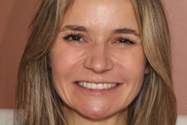 Smile Makeover Before & After Gallery - Patient 39578467 - Image 2