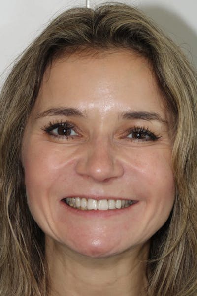 Smile Makeover Before & After Gallery - Patient 39578467 - Image 3