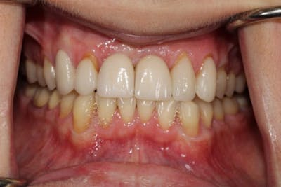 Smile Makeover Before & After Gallery - Patient 39578467 - Image 5