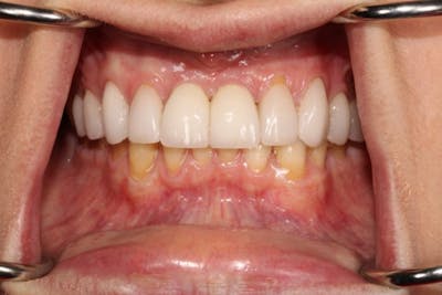 Smile Makeover Before & After Gallery - Patient 39578467 - Image 6