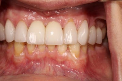 Smile Makeover Gallery - Patient 39578467 - Image 7