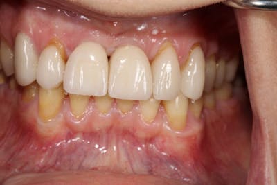 Smile Makeover Before & After Gallery - Patient 39578467 - Image 8
