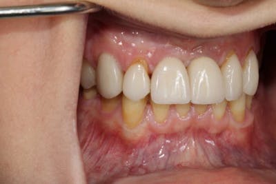 Smile Makeover Before & After Gallery - Patient 39578467 - Image 9
