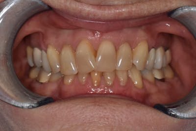 Veneers Before & After Gallery - Patient 39578470 - Image 1