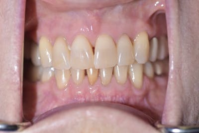 Veneers Before & After Gallery - Patient 39578470 - Image 2