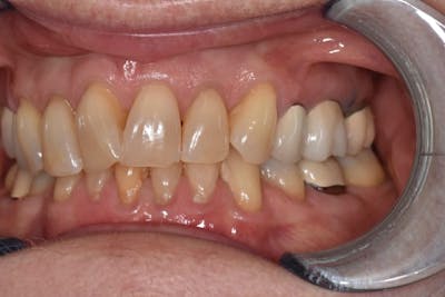 Veneers Before & After Gallery - Patient 39578470 - Image 3