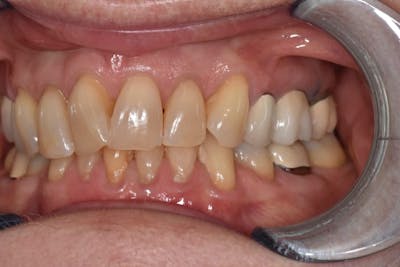 Veneers Before & After Gallery - Patient 39578470 - Image 3