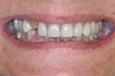 Veneers Before & After Gallery - Patient 39578479 - Image 1