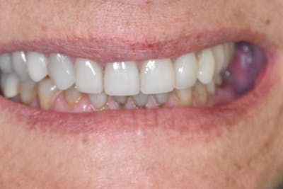 Veneers Before & After Gallery - Patient 39578479 - Image 2